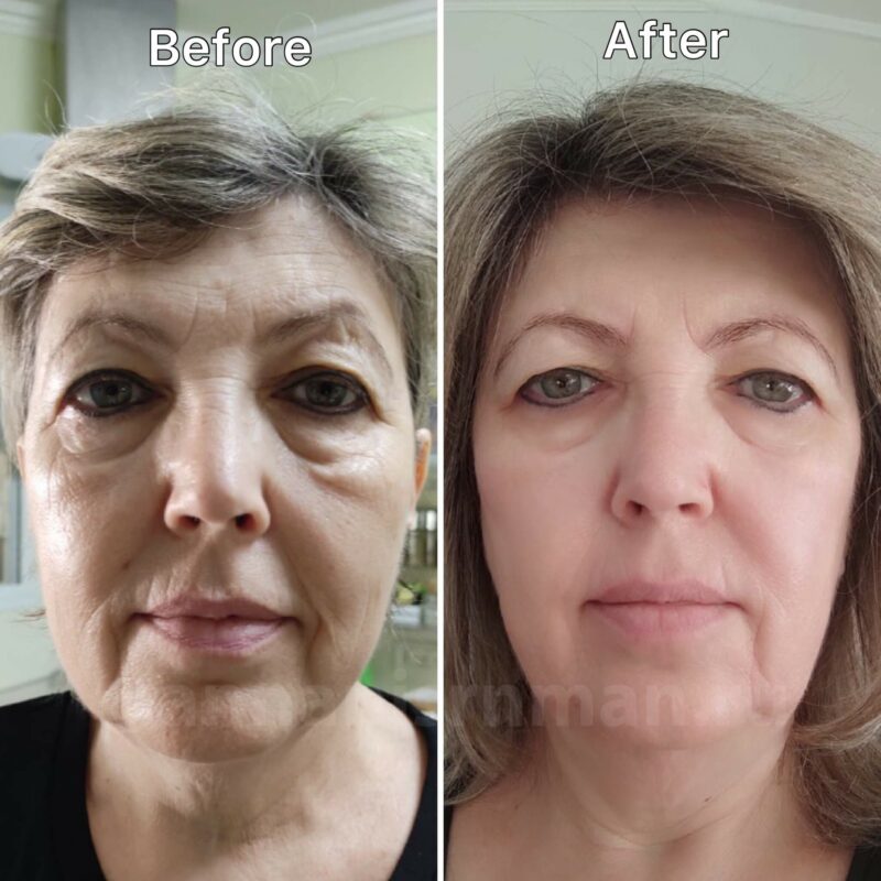 Before and after 1