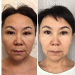step 2 before after 5