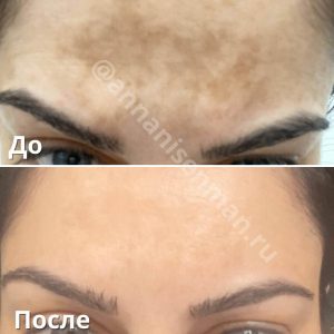 before after 1