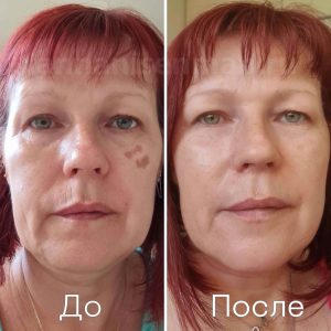 before after 4